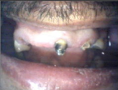 Before Treatment